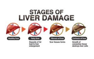 Signs of Liver Problems