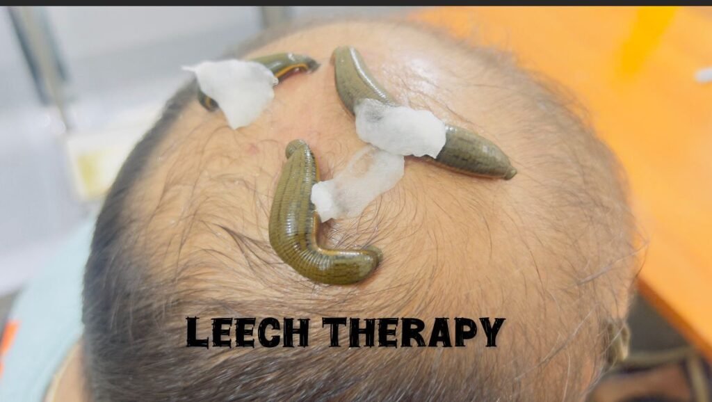 Hair fall treatment in Ayurveda for leach